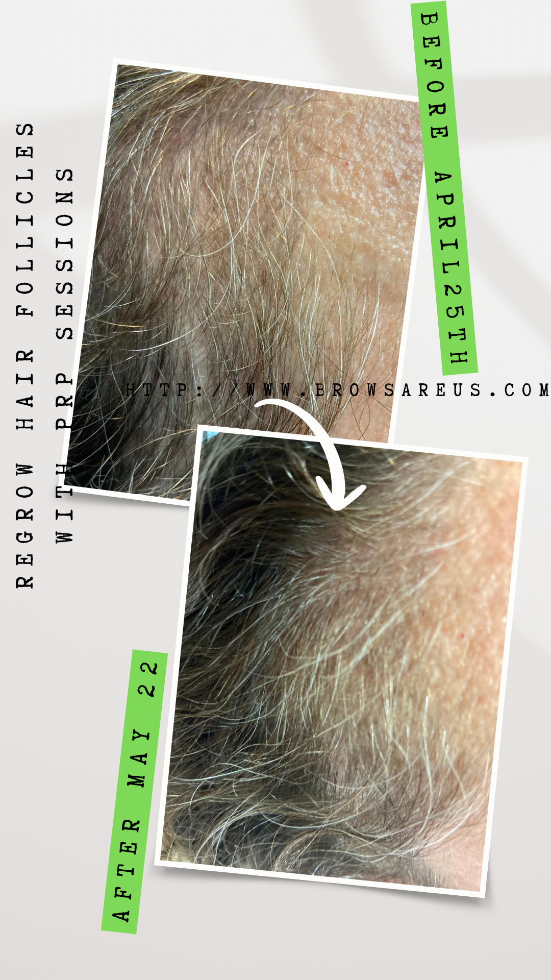 Thinning Hair? Try PRP in Raleigh