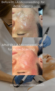 Best Acne Scar Treatment in North Carolina: PLLA Microsculpting at Brows Are Us