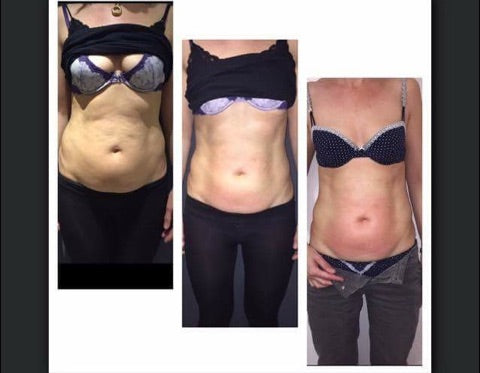 Transform in 6 with Cool Sculpting - Raleigh, Burlington, NC