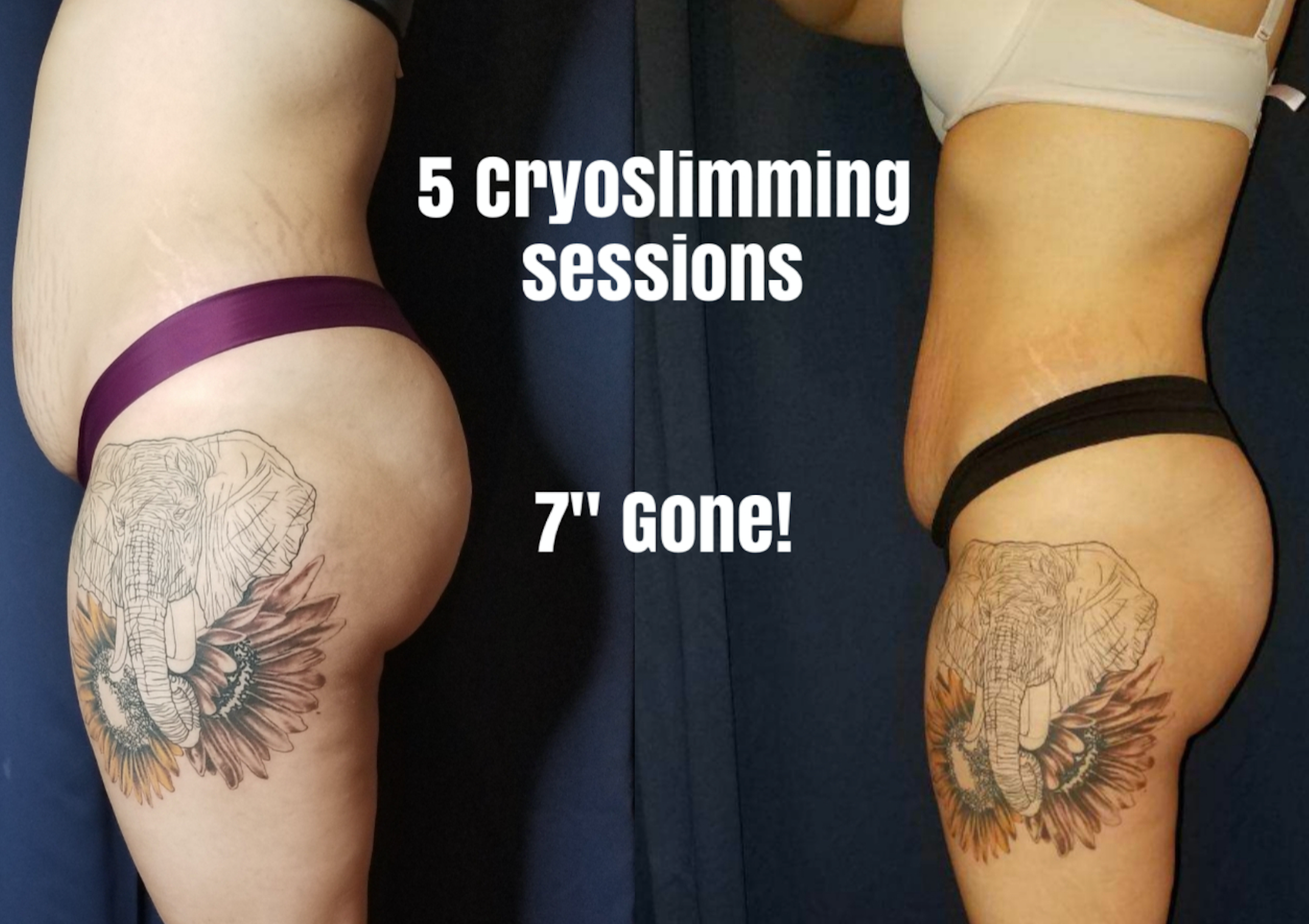 Transform in 6 with Cool Sculpting - Raleigh, Burlington, NC