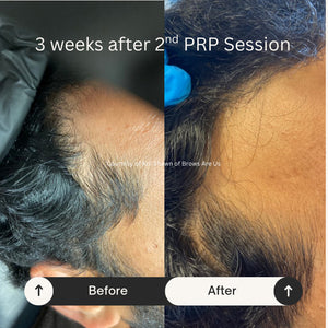 PRP Hair Restoration - Raleigh & Burlington, NC