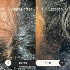 PRP Hair Restoration - Raleigh & Burlington, NC