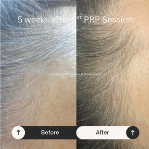 PRP Hair Restoration - Raleigh & Burlington, NC