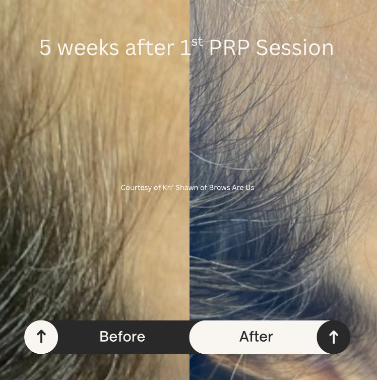 PRP Hair Restoration - Raleigh & Burlington, NC