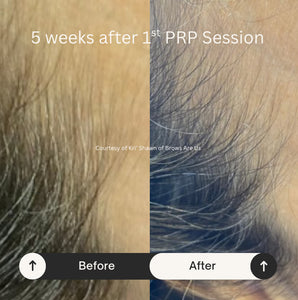 PRP Hair Restoration - Raleigh & Burlington, NC