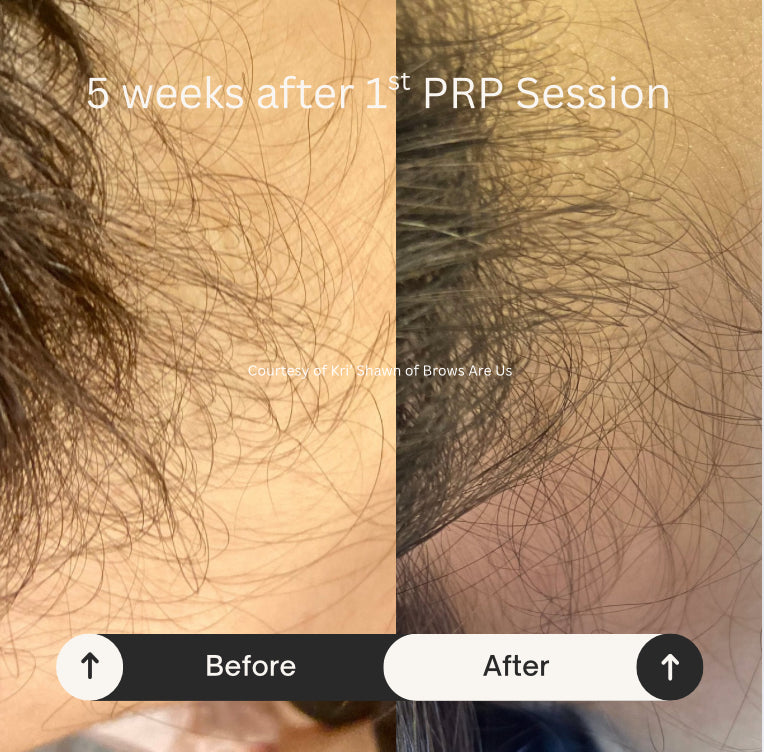 PRP Hair Restoration - Raleigh & Burlington, NC