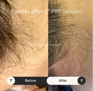 PRP Hair Restoration - Raleigh & Burlington, NC