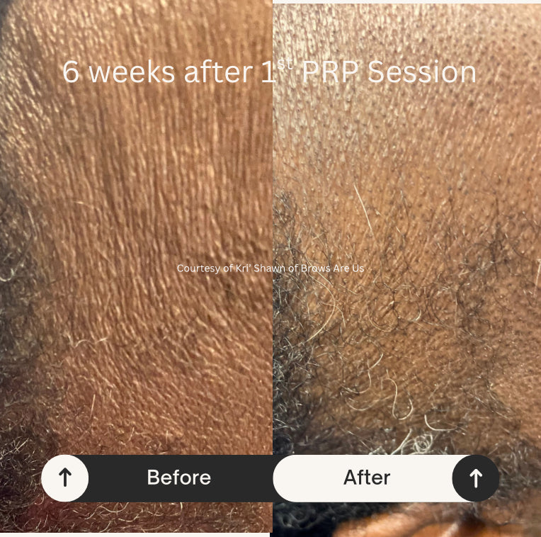 PRP Hair Restoration - Raleigh & Burlington, NC
