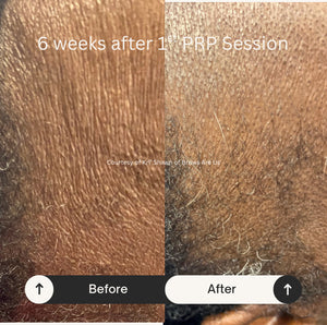 PRP Hair Restoration - Raleigh & Burlington, NC