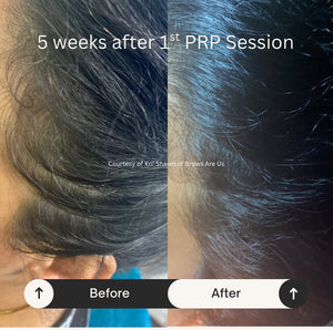 PRP Hair Restoration - Raleigh & Burlington, NC