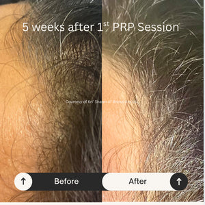 PRP Hair Restoration - Raleigh & Burlington, NC