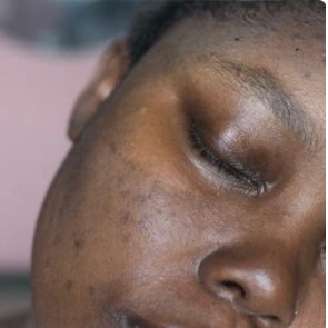 Remove Dark Spots and Hyperpigmentation with Non Invasive Skin Lightening: Burlington, Greensboro, Chapel Hill, Raleigh, NC