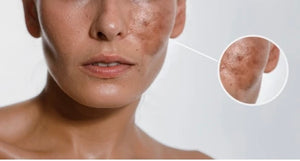 Remove Dark Spots and Hyperpigmentation with Non Invasive Skin Lightening: Burlington, Greensboro, Chapel Hill, Raleigh, NC