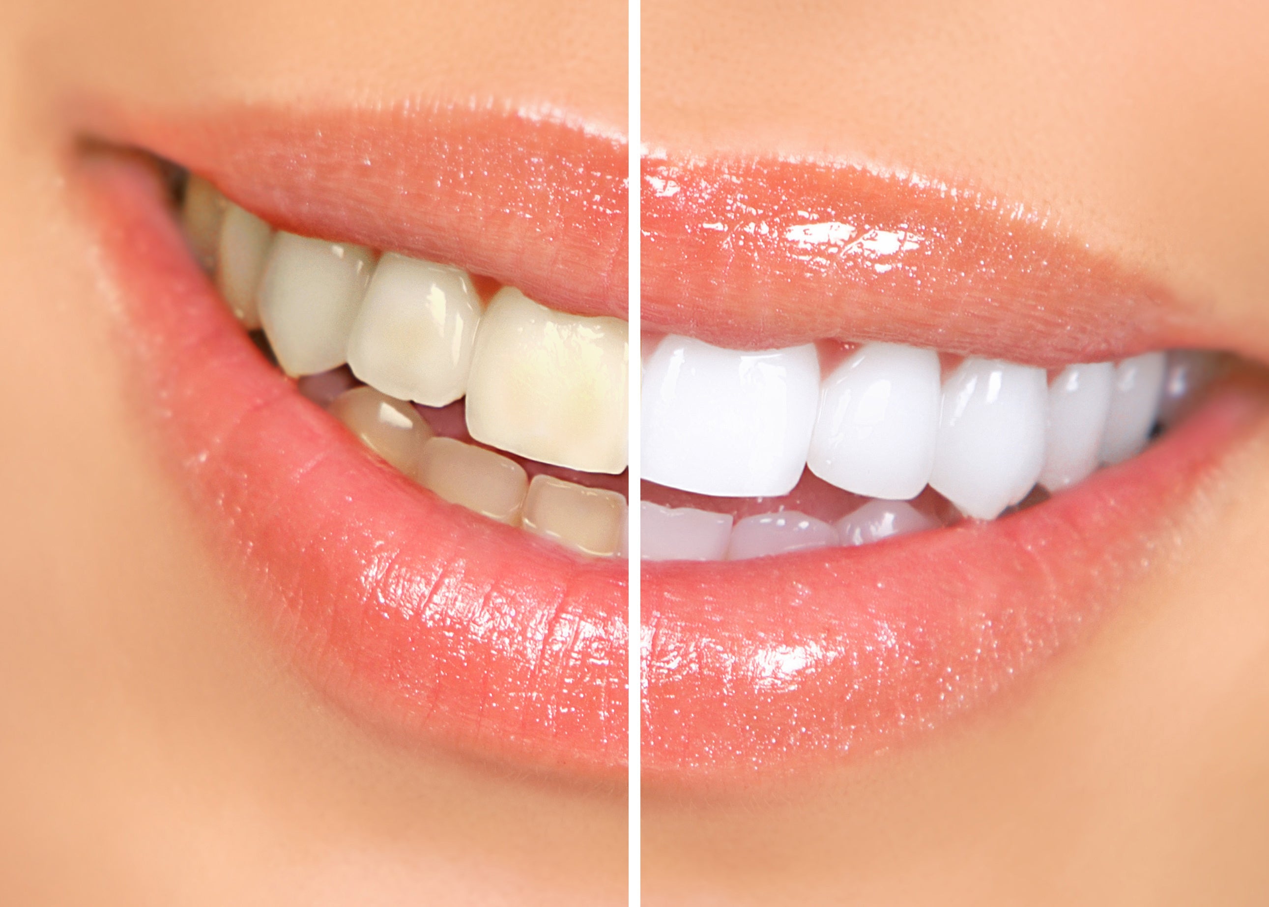 Teeth Whitening Pro Certification: One-Day Training to Brighten Smiles and Boost Income