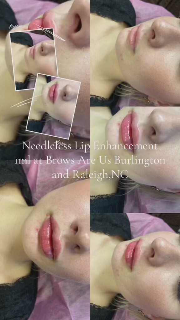 Needleless Lip Enhancement | Brows Are Us — Burlington NC | Raleigh NC