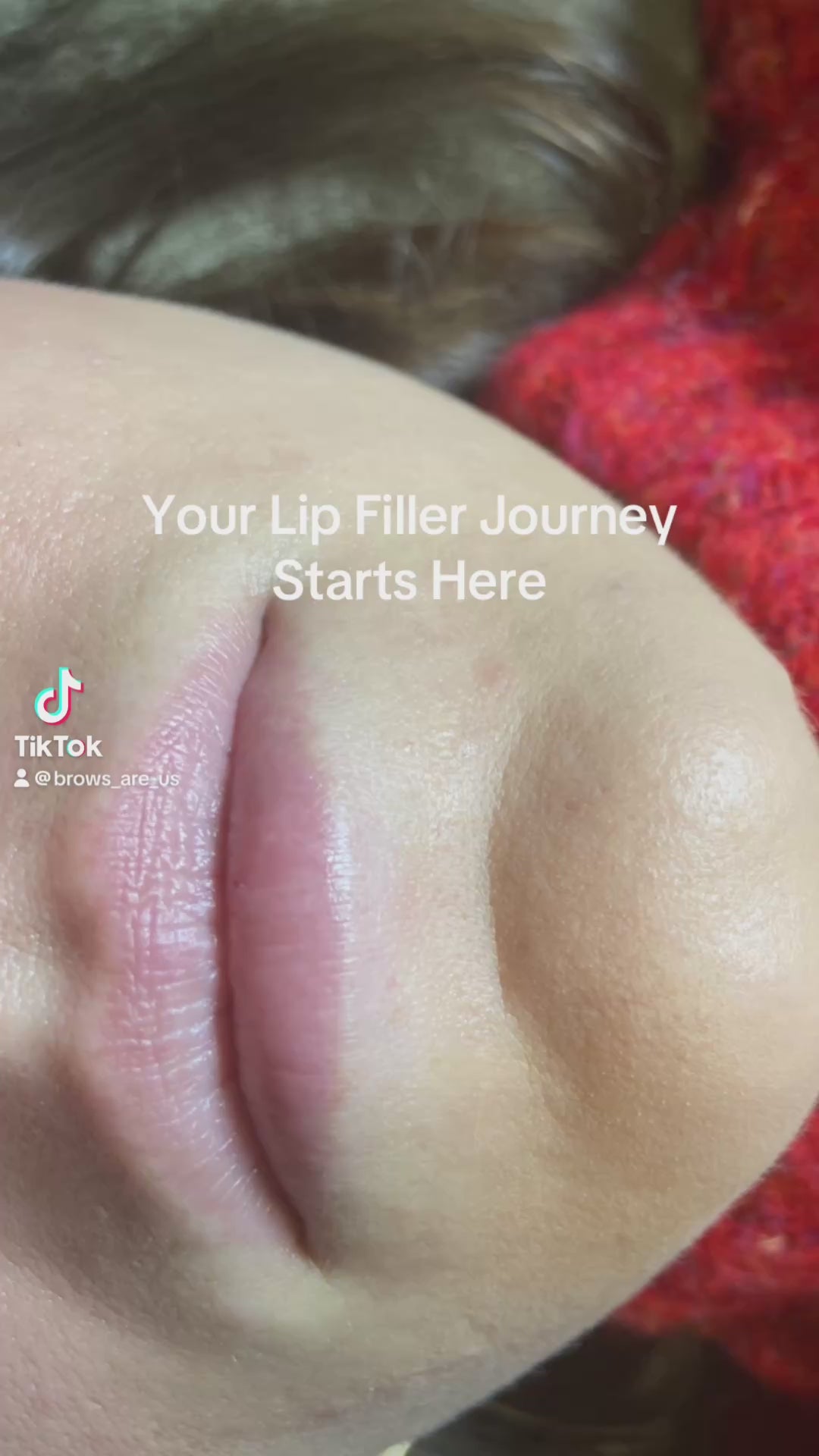 Get Lucious Lips with Needleless Lip Filler - Burlington,Raleigh, NC