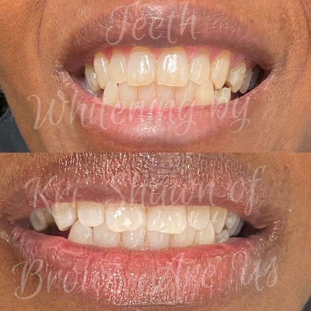 Teeth Whitening Raleigh NC - Teeth Whitening | NCBodyMetrics