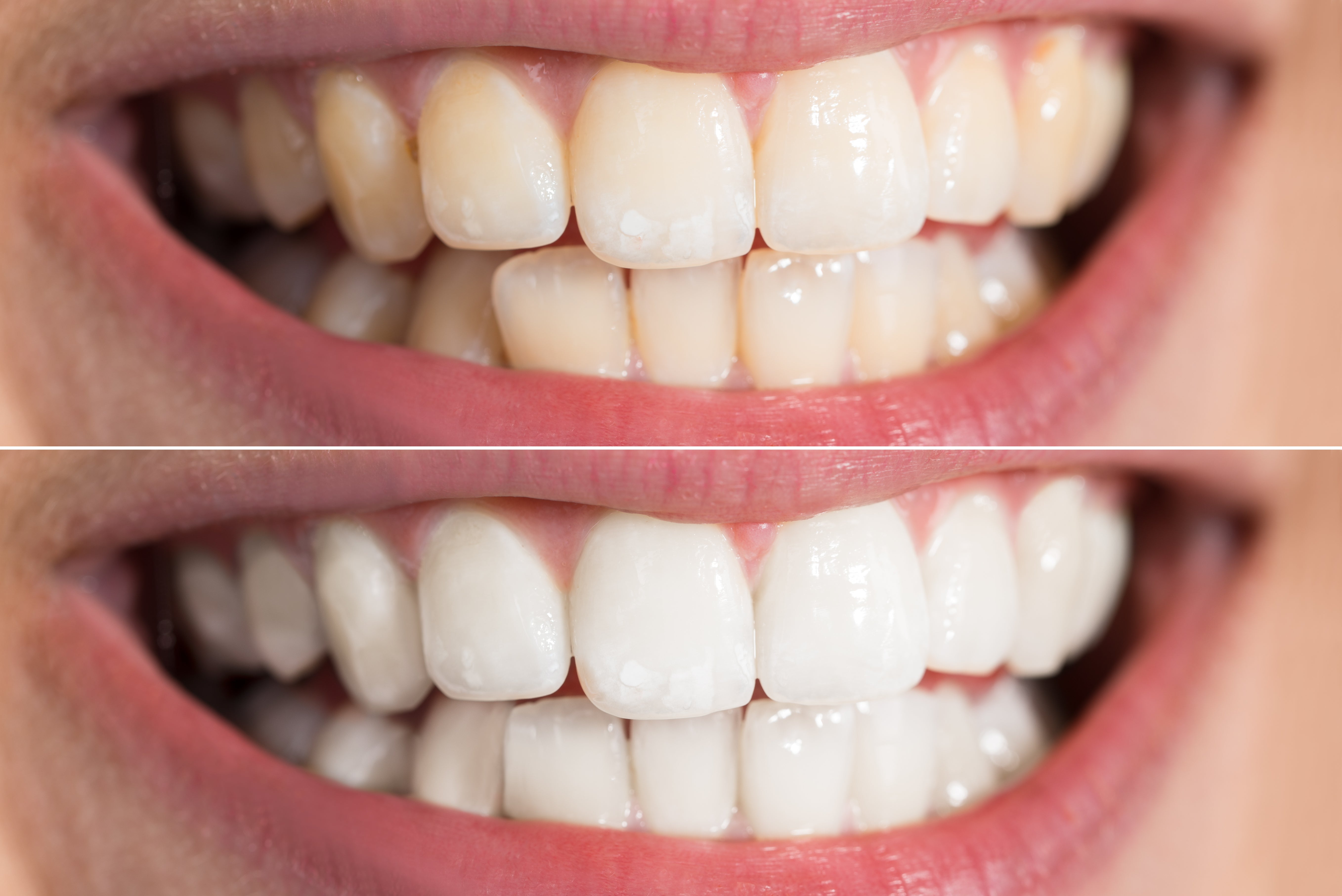 Teeth Whitening Raleigh NC - Teeth Whitening | NCBodyMetrics