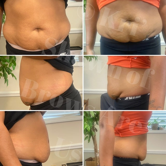 6 Session Body Cavitation Silver Package Burlington, Raleigh, Charlotte, NC