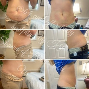 Fat Removal Surgery - Fat Cavitation | NCBodyMetrics