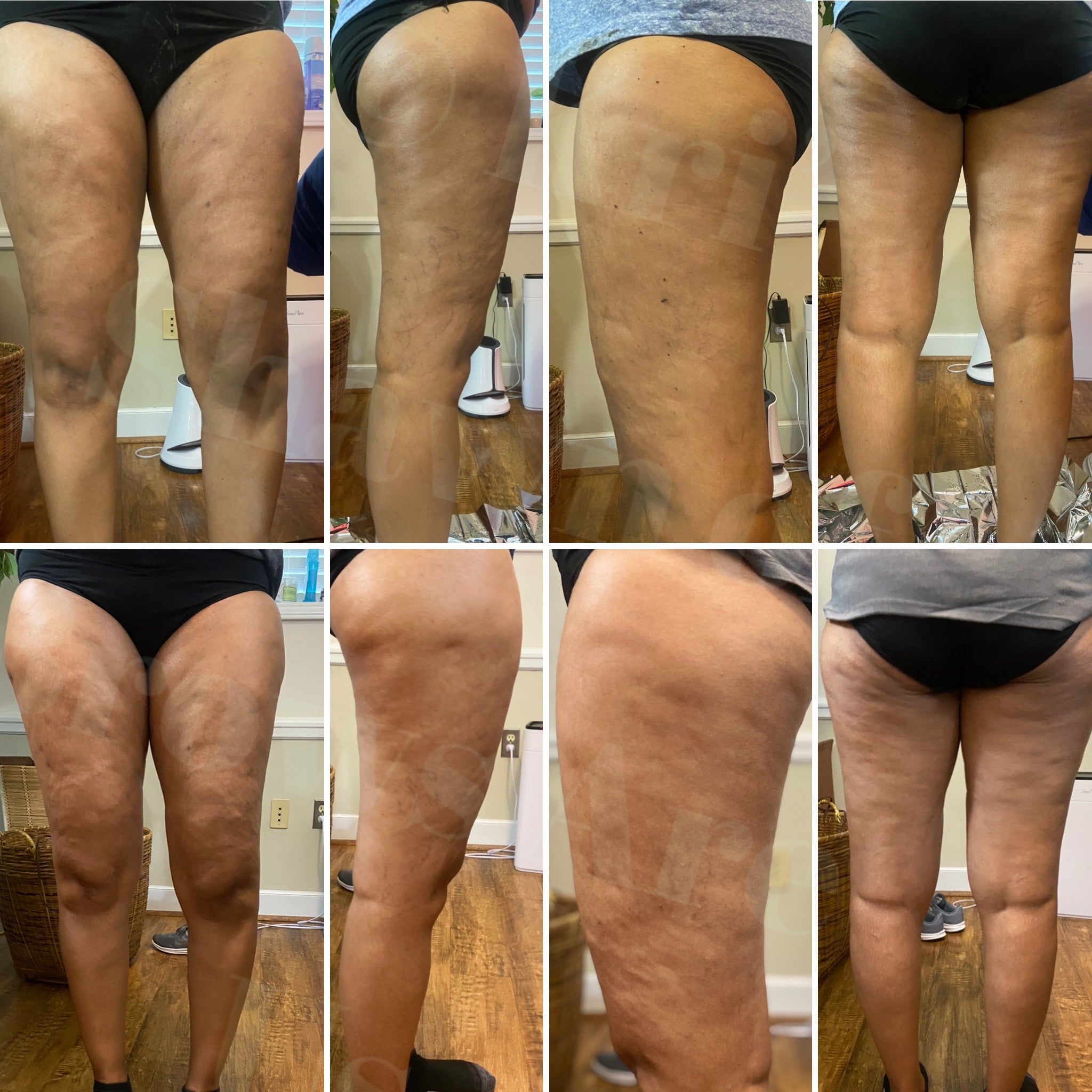 body sculpting los angeles